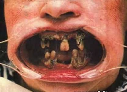 rotten teeth Pictures, Images and Photos